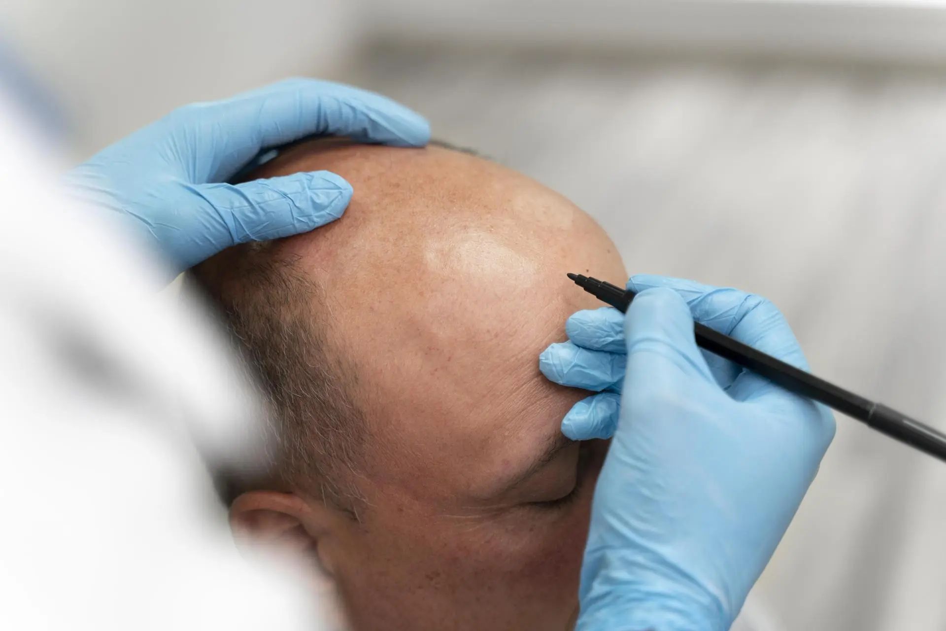 FUE – Follicular Unit Extraction